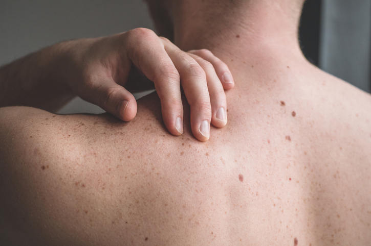 Prevención del Cáncer de Piel
