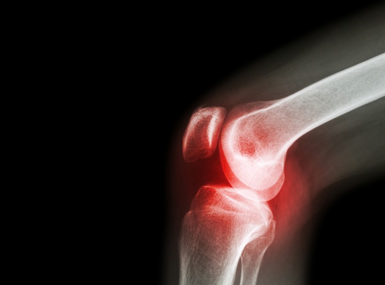 Remedios contra el dolor de rodilla