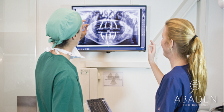Implantes dentales, los mejores aliados para tu salud bucodental