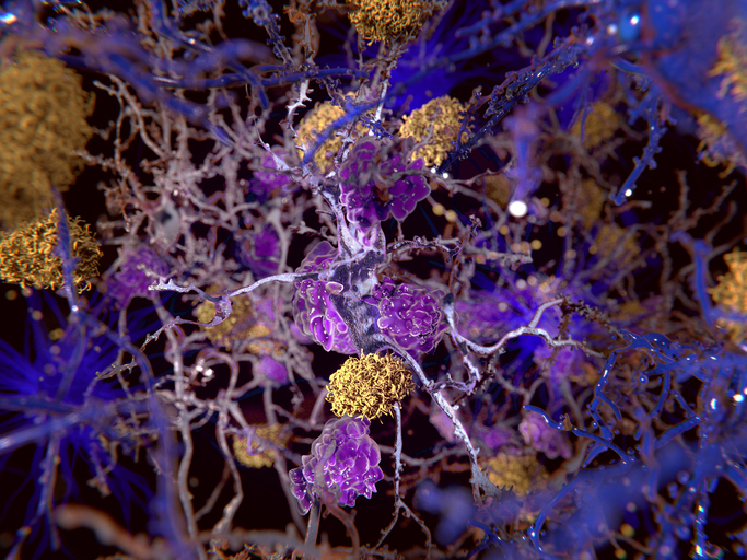 enfermedad de Alzheimer