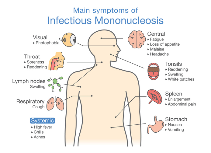 ¿Qué causa la mononucleosis?