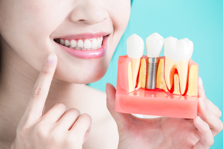Salud bucodental: los implantes dentales