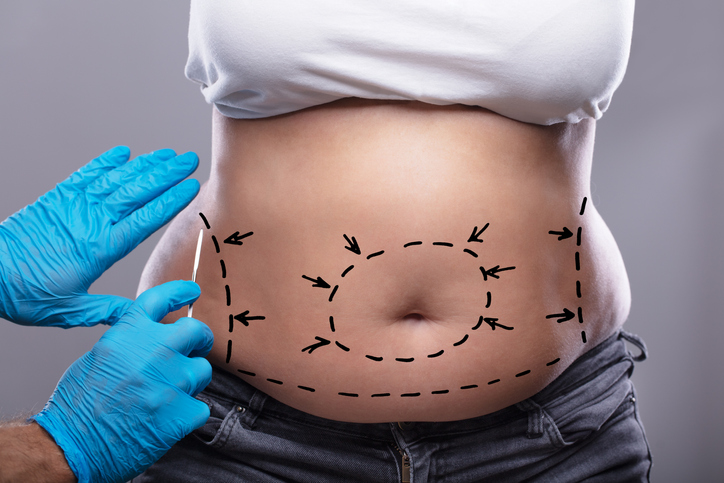 La cirugía estética post bariátrica