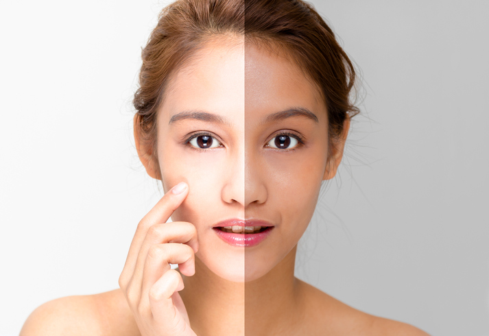 ¿Cómo solucionar la asimetría facial?