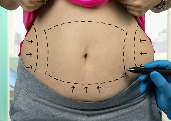 ¿Qué es la abdominoplastia?