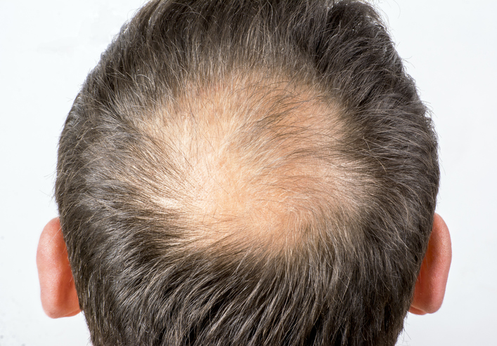 Pérdida de pelo en la coronilla e injerto capilar: ¿Qué puedes esperar?