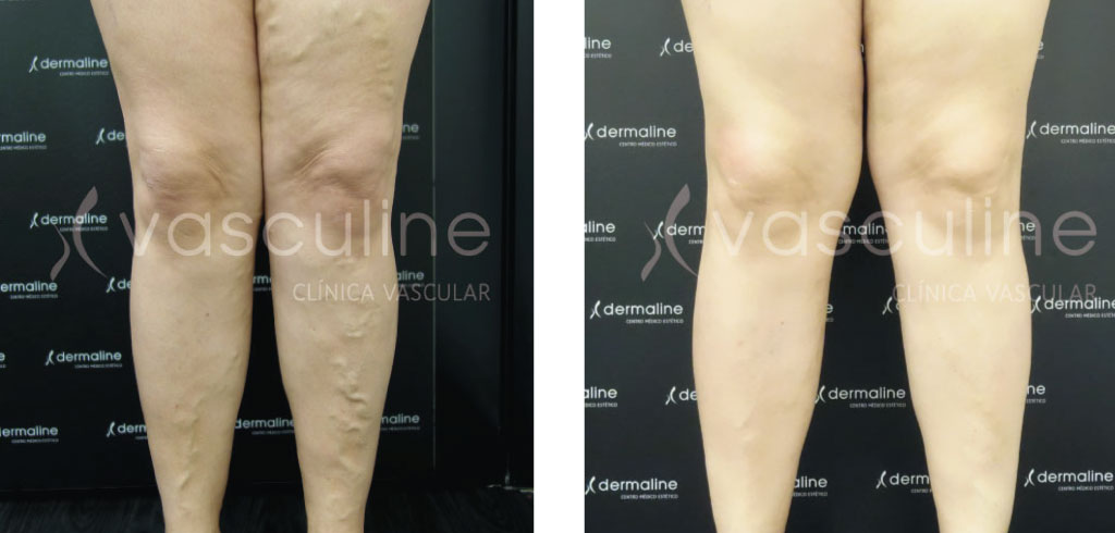 ¿Qué técnicas poco invasivas existen para eliminar las varices?