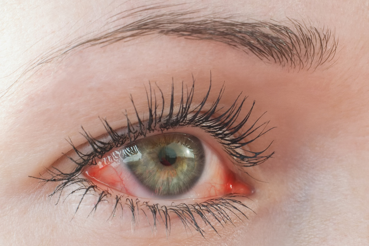 Queratitis: Qué es, síntomas y tratamiento