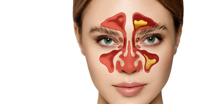 Tratamientos para la sinusitis