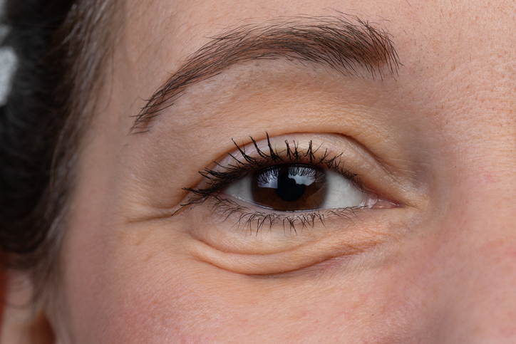 ¿Qué es la blefaroplastia o la operación de párpados? ¡Lo que debes saber!
