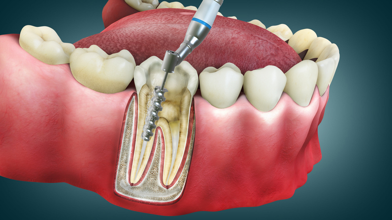 Material de endodoncia: garantía de calidad a precios competitivos