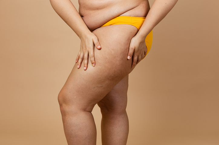 El mayor estudio clínico sobre lipedema realizado en España analiza a más de 1.800 mujeres